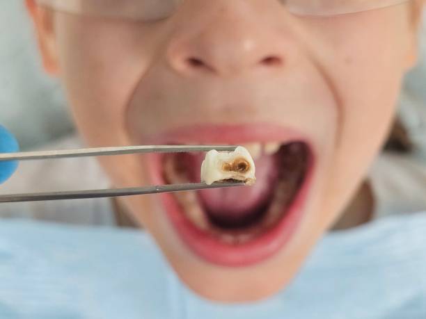 Best Knocked-Out Tooth (Avulsed Tooth) Treatment in Syracuse, UT